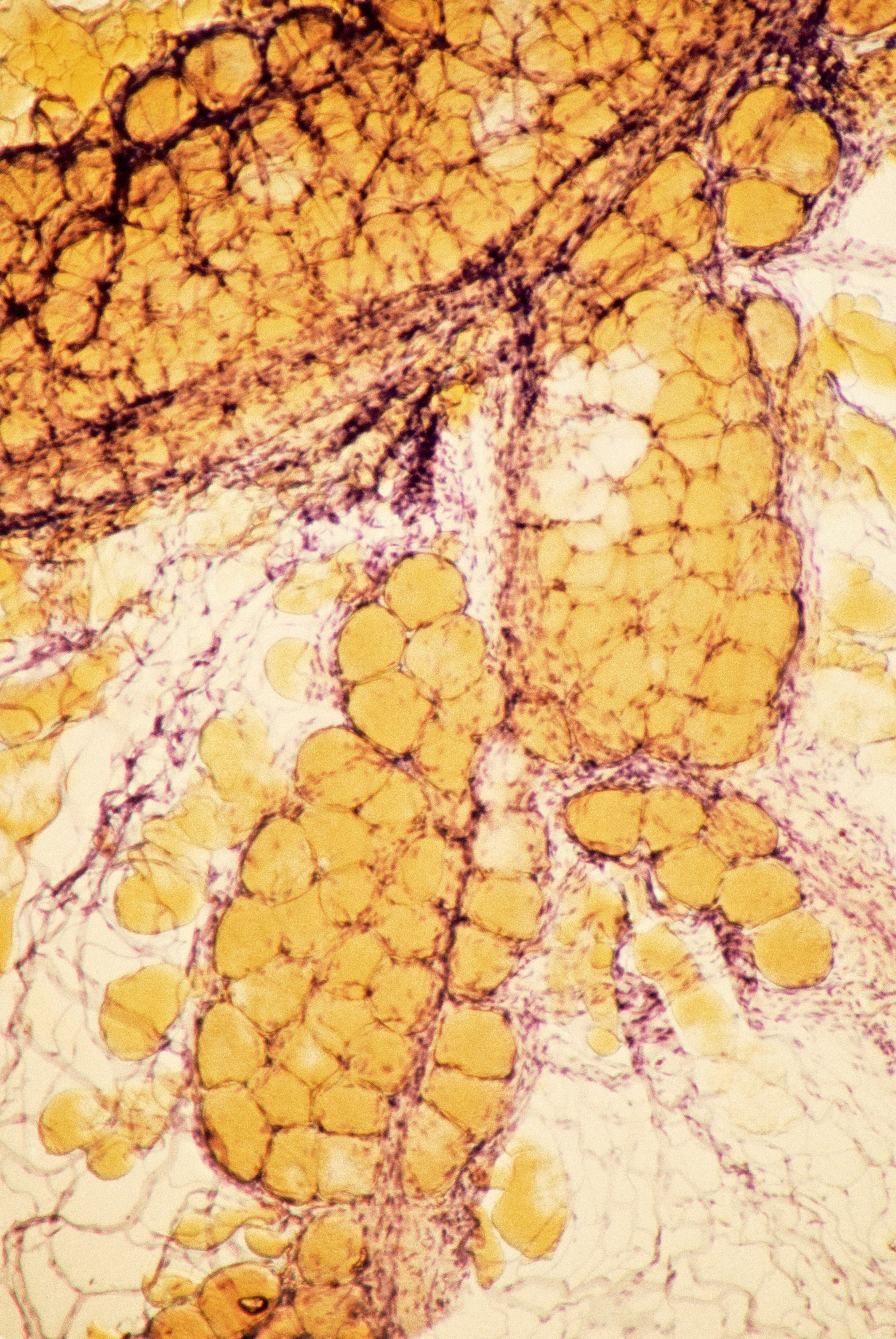Prevencija arterioskleroze Prevencija arterioskleroze